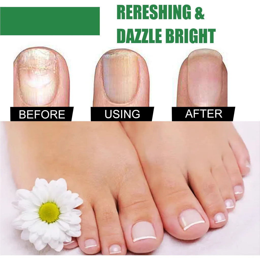 30ml bottle of tea tree oil nail repair fluid for hand and foot nail care