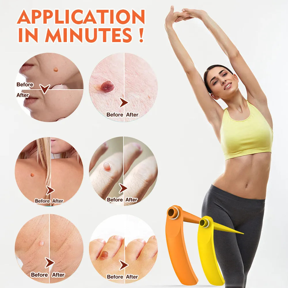 Orange-yellow wart removal tool kit with two handheld devices, rubber rings, alcohol swabs, and a repair sticker.