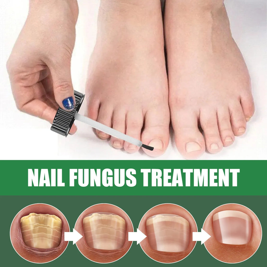 30ml bottle of tea tree oil nail repair fluid for hand and foot nail care