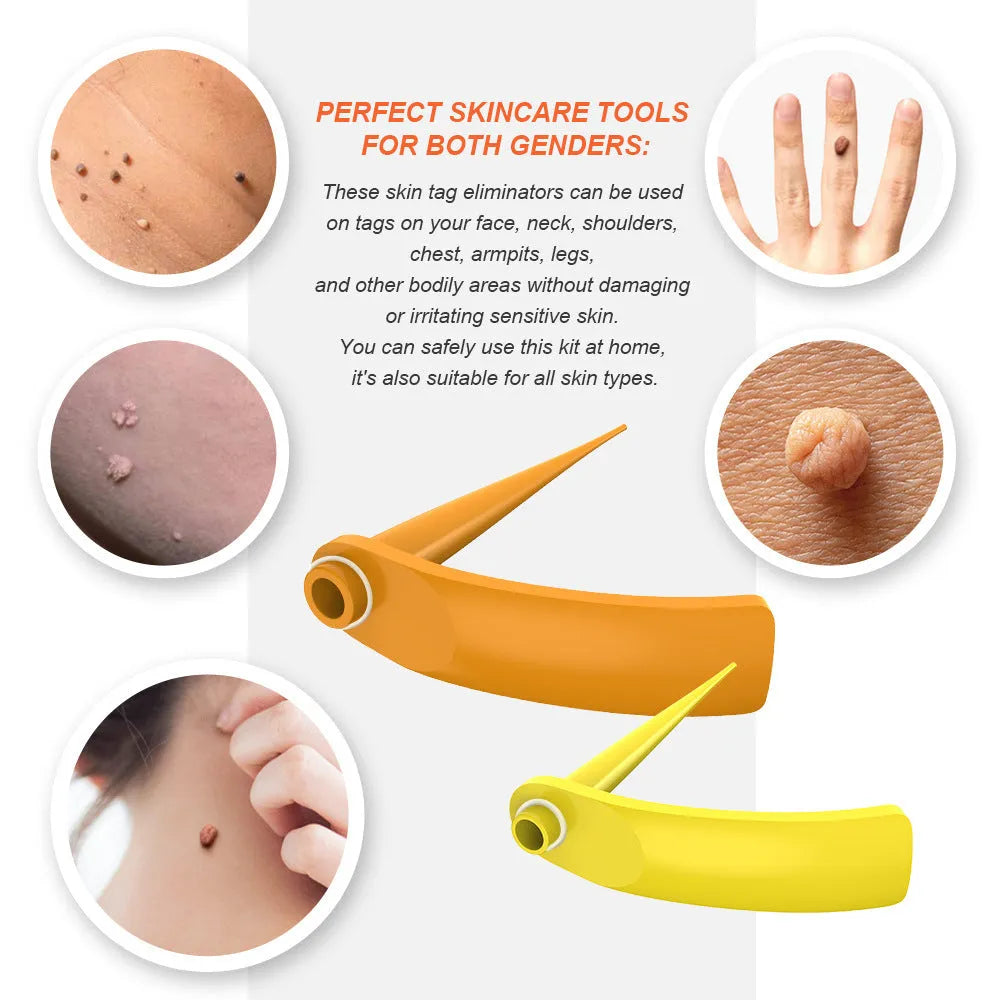 Orange-yellow wart removal tool kit with two handheld devices, rubber rings, alcohol swabs, and a repair sticker.